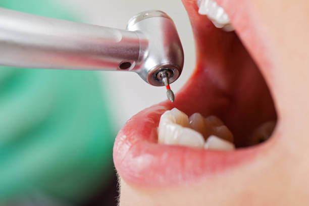 Best Lost Filling or Crown Replacement in Brookings, OR